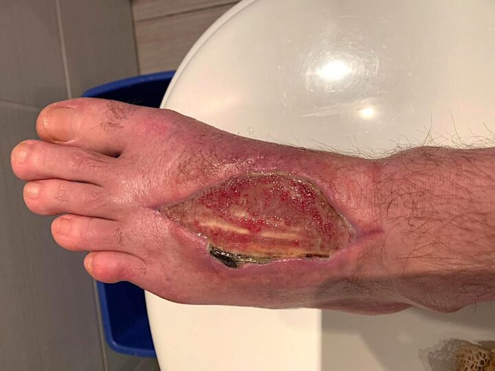 Инфицированная рана / Infected wound