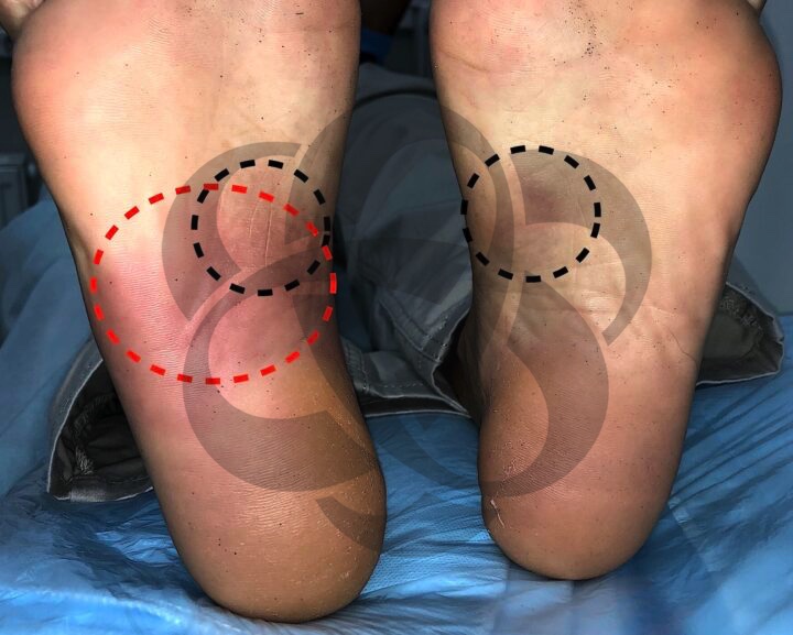 Болезнь Леддерхозе, подошвенный фиброматоз / Ledderhose's disease, plantar fibromatosis